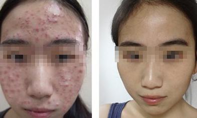 我院痤疮治疗前后对比图